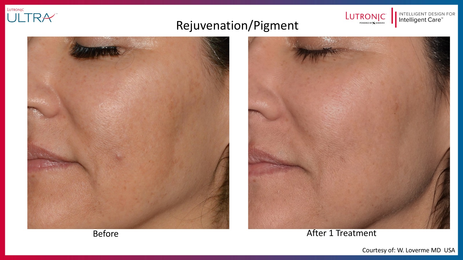 LaseMD Ultra Before and After - Pigmentation Treatment